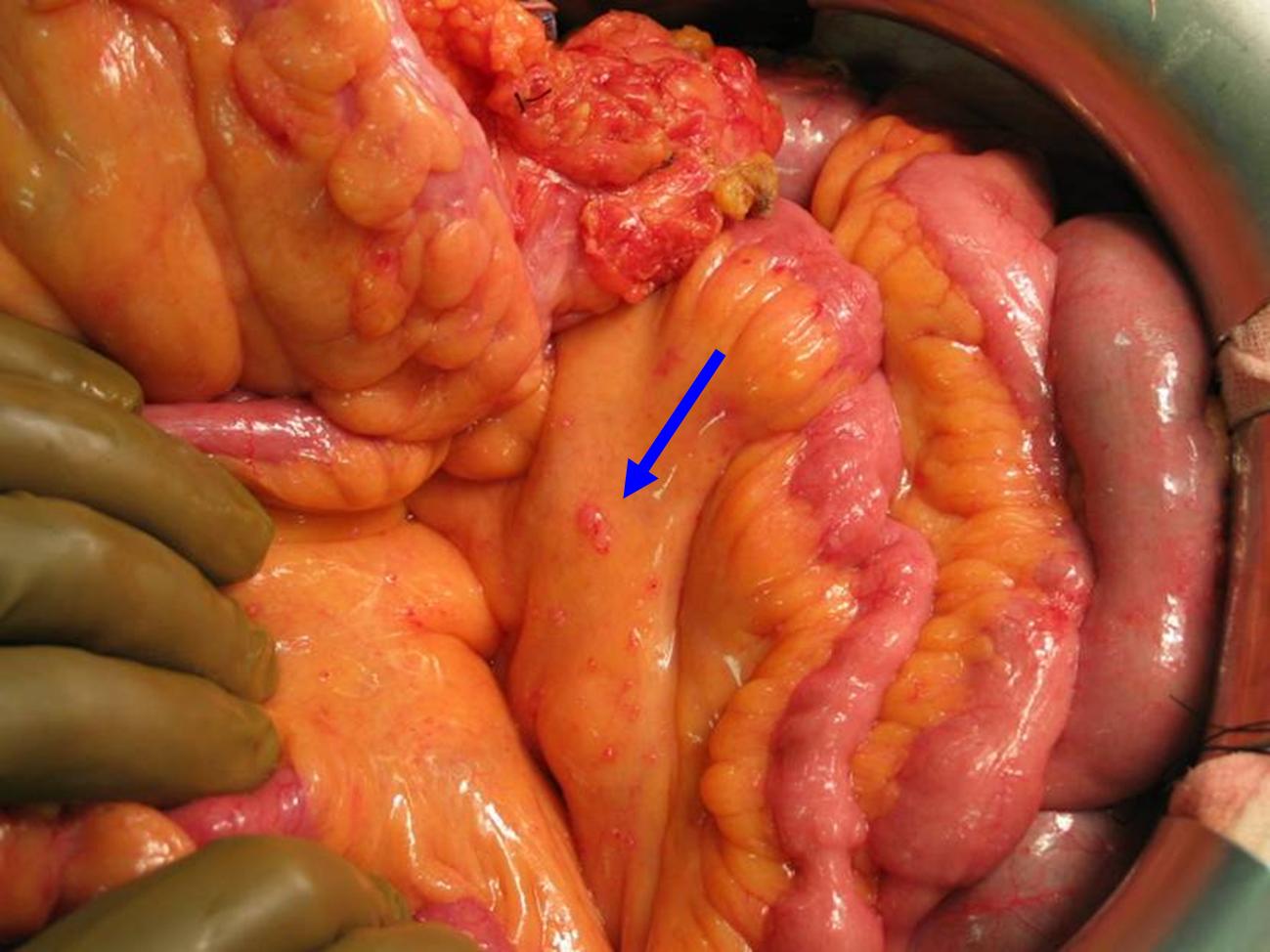 can see the small bowel,