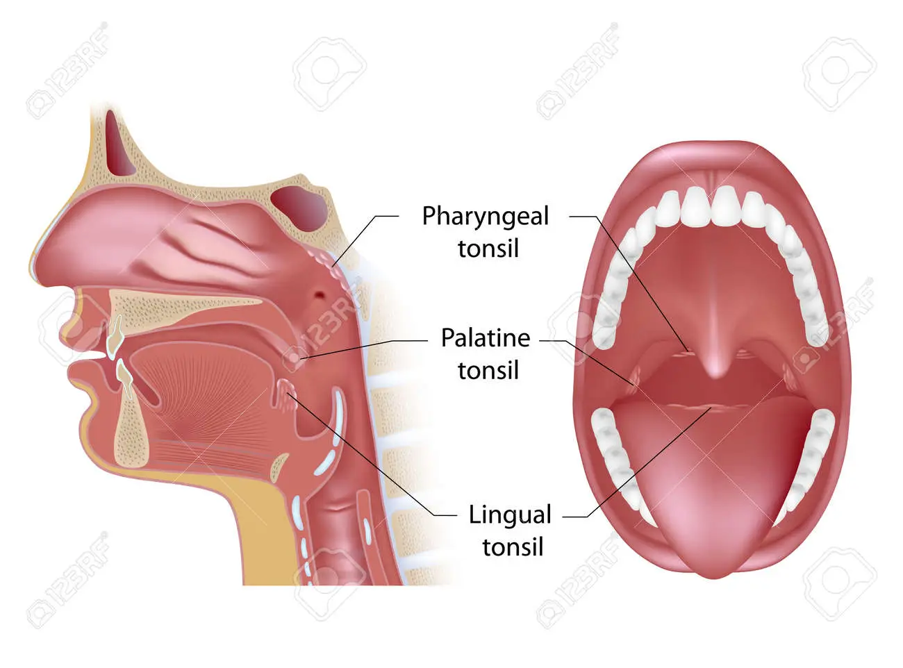 Tonsils in open mouth and