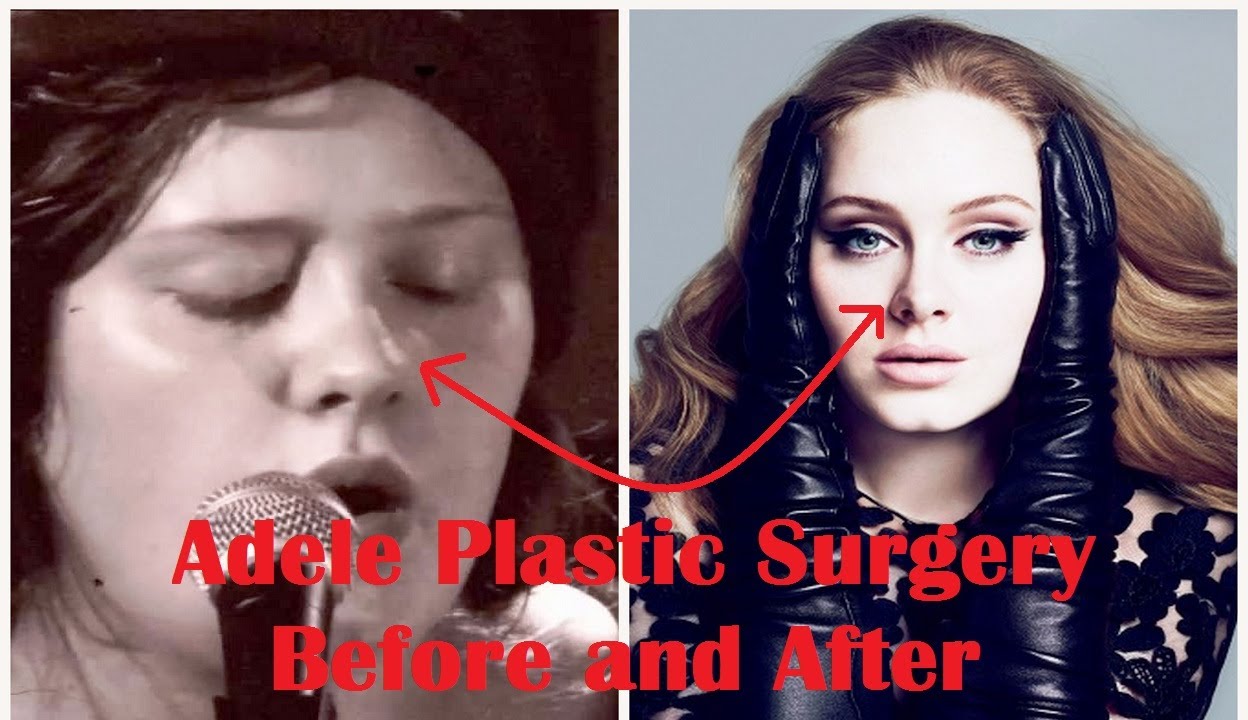 Adele Plastic Surgery Before